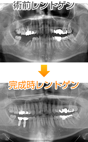 術前レントゲン・完成時レントゲン